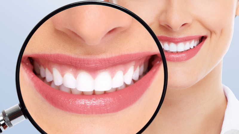 Todo Sobre los Blanqueamientos Dentales